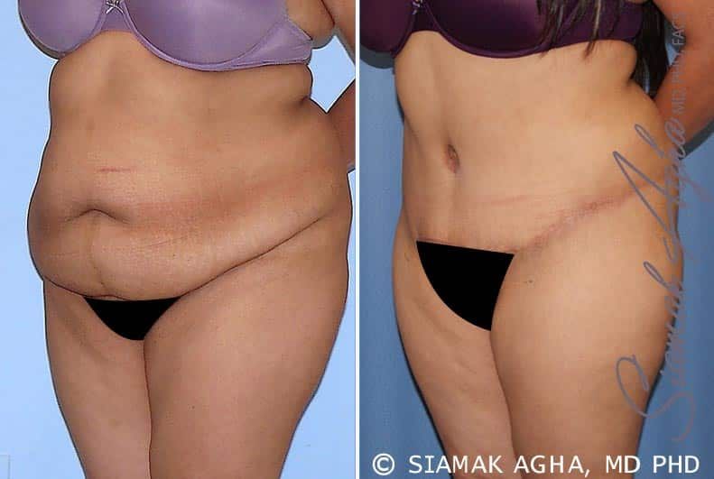 Tummy Tuck Before & After