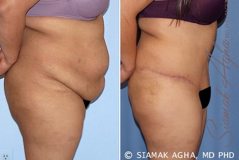 Tummy Tuck Before & After