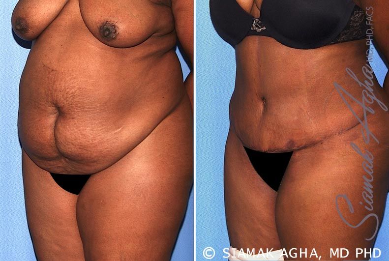 Tummy Tuck Before & After