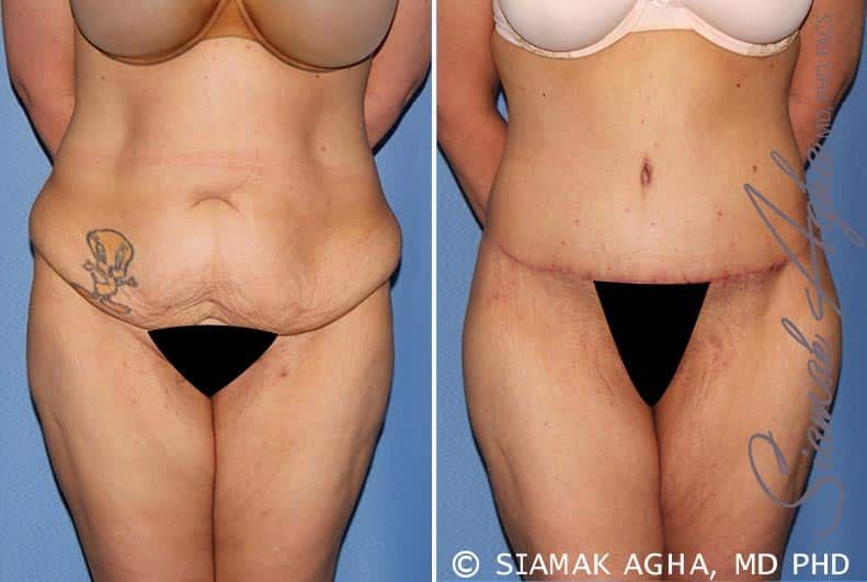 Tummy Tuck Before & After