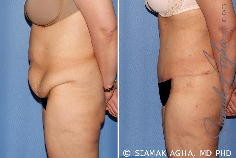 Tummy Tuck Before & After