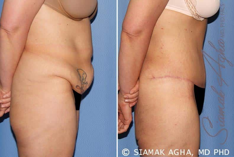 Tummy Tuck Before & After