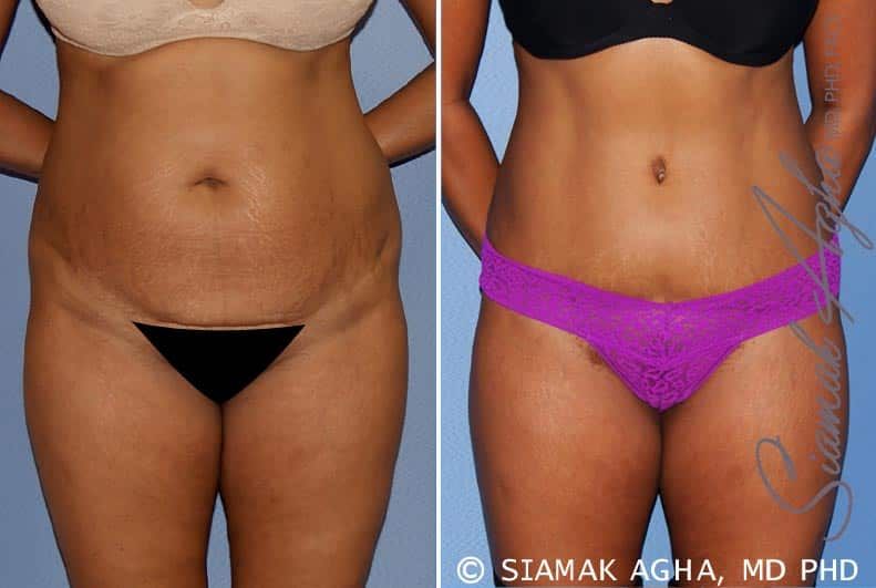 Tummy Tuck Before & After