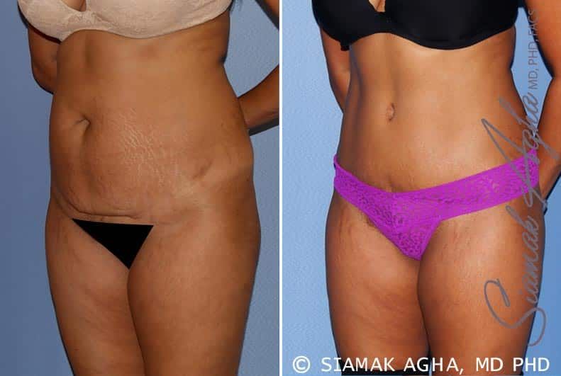 Tummy Tuck Before & After