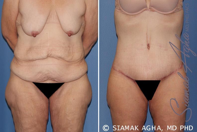 Tummy Tuck Before & After