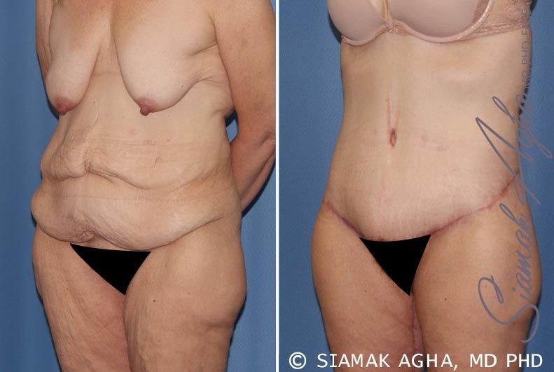 Tummy Tuck Before & After