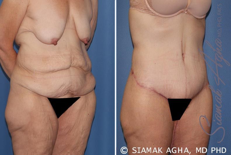 Tummy Tuck Before & After