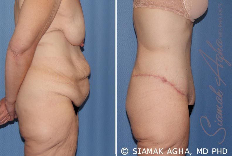 Tummy Tuck Before & After