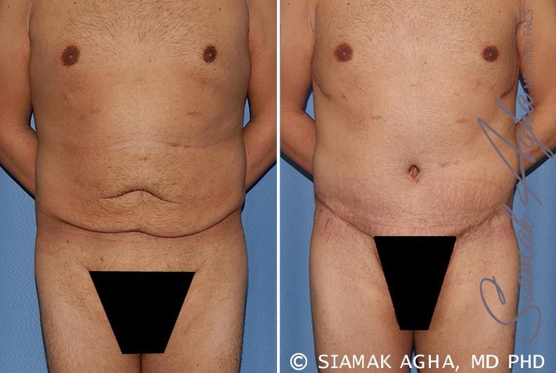 Tummy Tuck Before & After