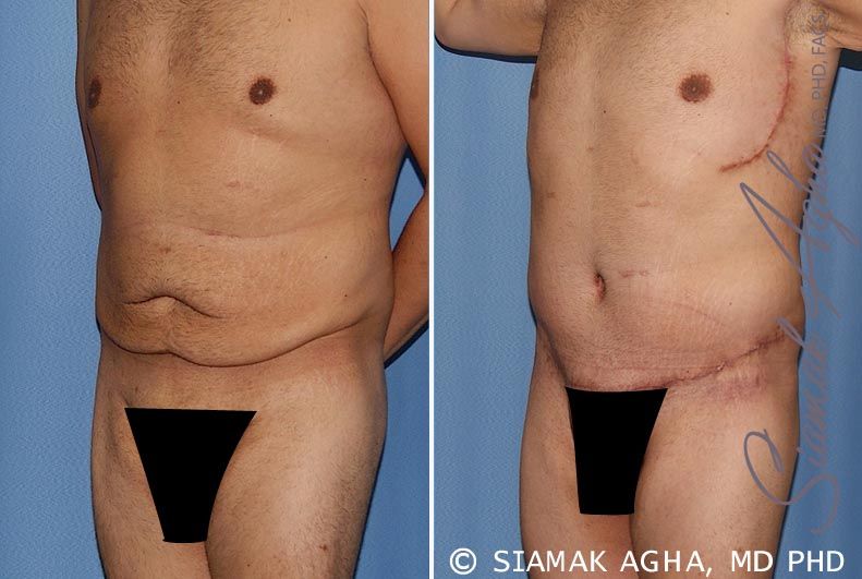 Tummy Tuck Before & After