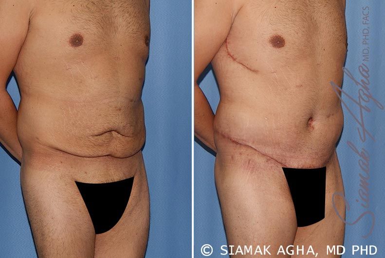 Tummy Tuck Before & After