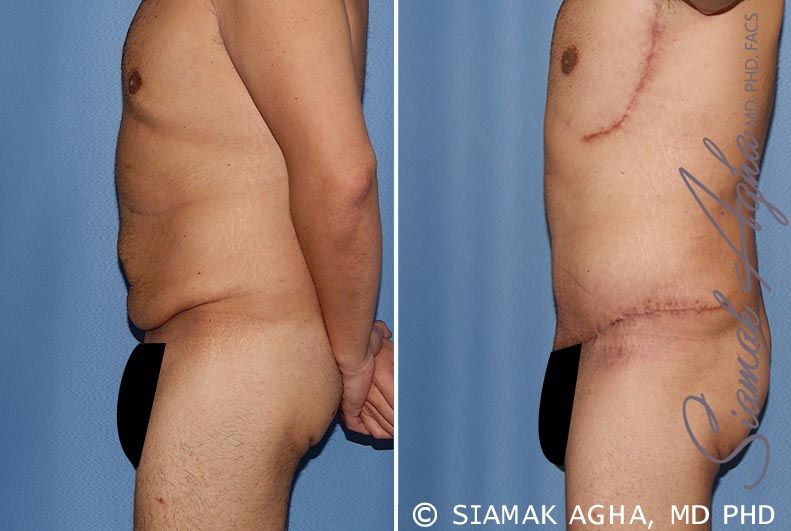 Tummy Tuck Before & After