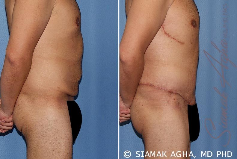 Tummy Tuck Before & After
