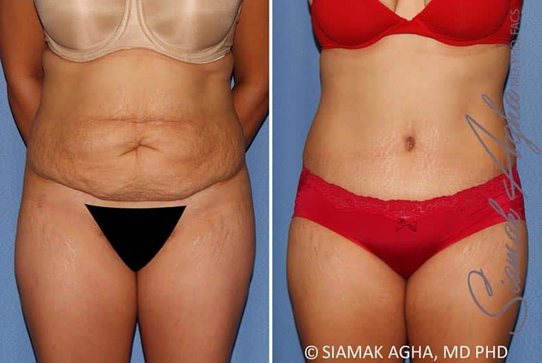 Tummy Tuck Before & After