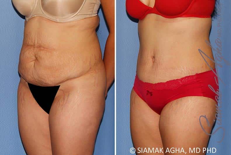 Tummy Tuck Before & After