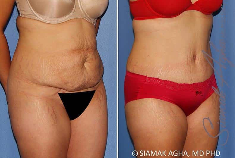Tummy Tuck Before & After