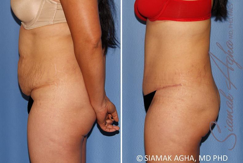 Tummy Tuck Before & After
