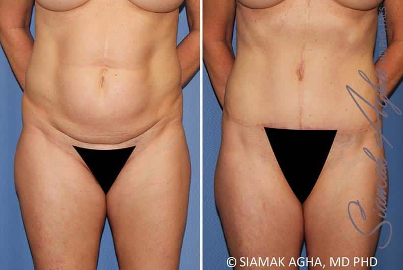 Tummy Tuck Before & After