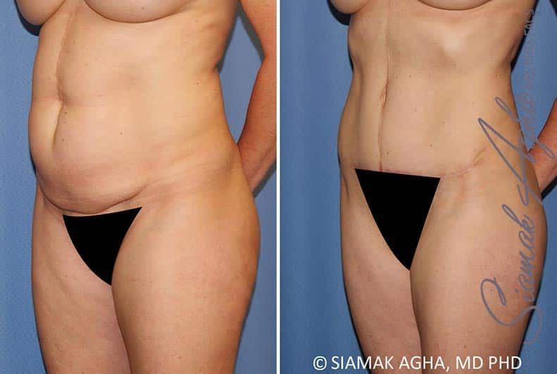 Tummy Tuck Before & After