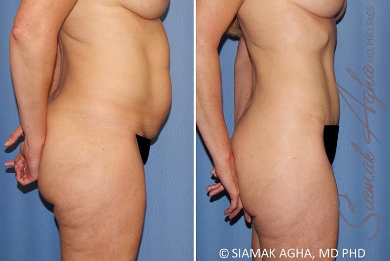 Tummy Tuck Before & After