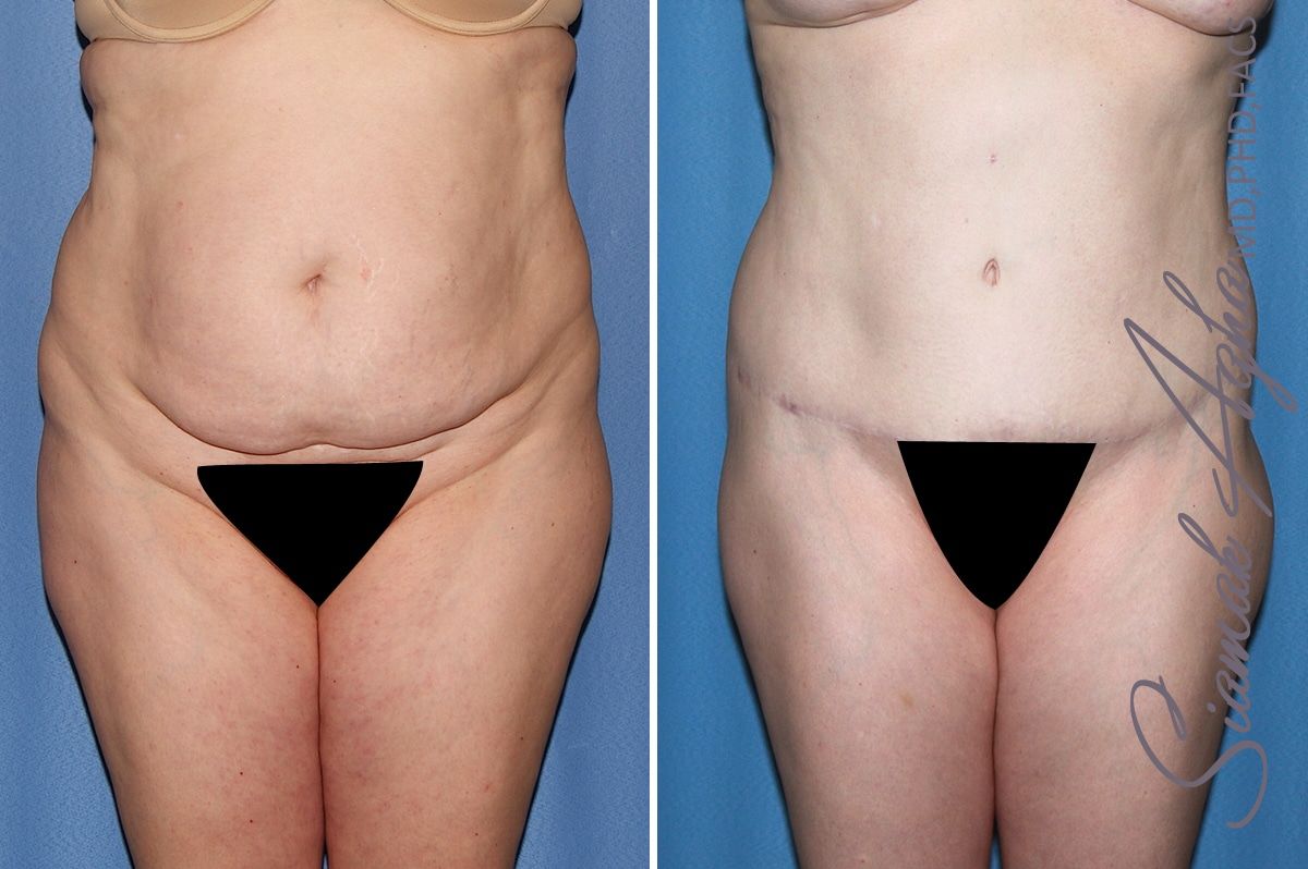 Tummy Tuck Before & After