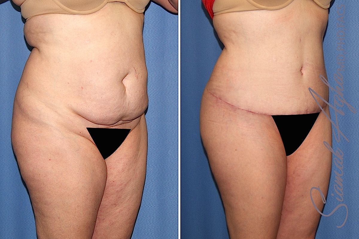 Tummy Tuck Before & After