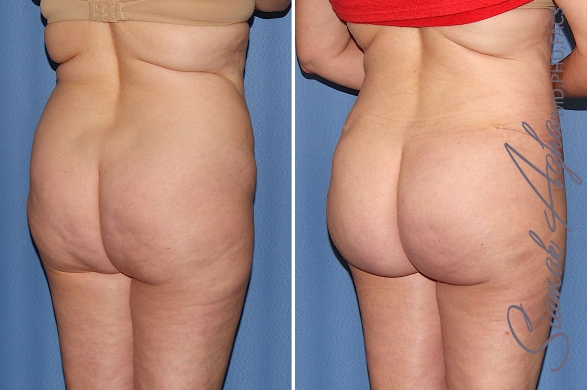 Tummy Tuck Before & After