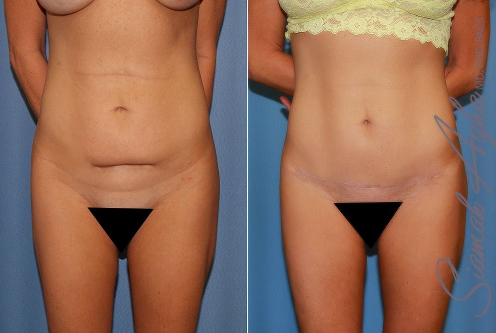 Tummy Tuck Before & After