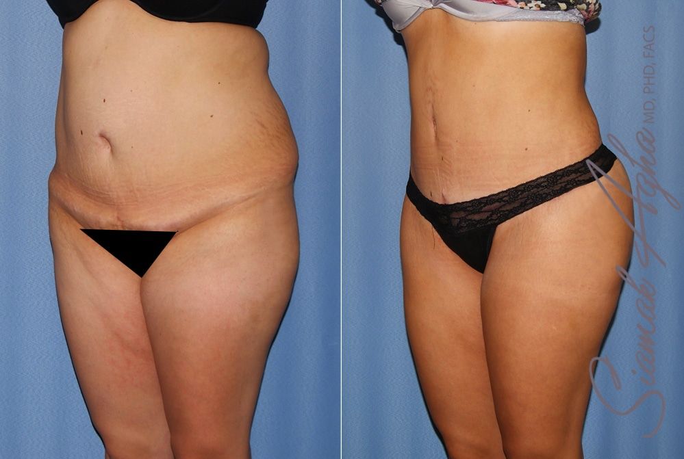 Tummy Tuck Before & After