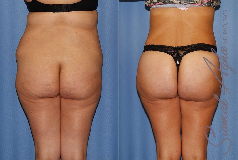 Tummy Tuck Before & After