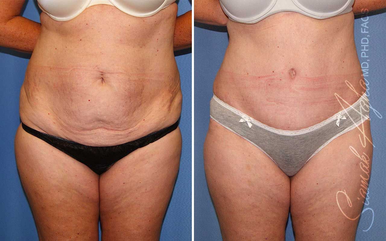 Tummy Tuck Before & After