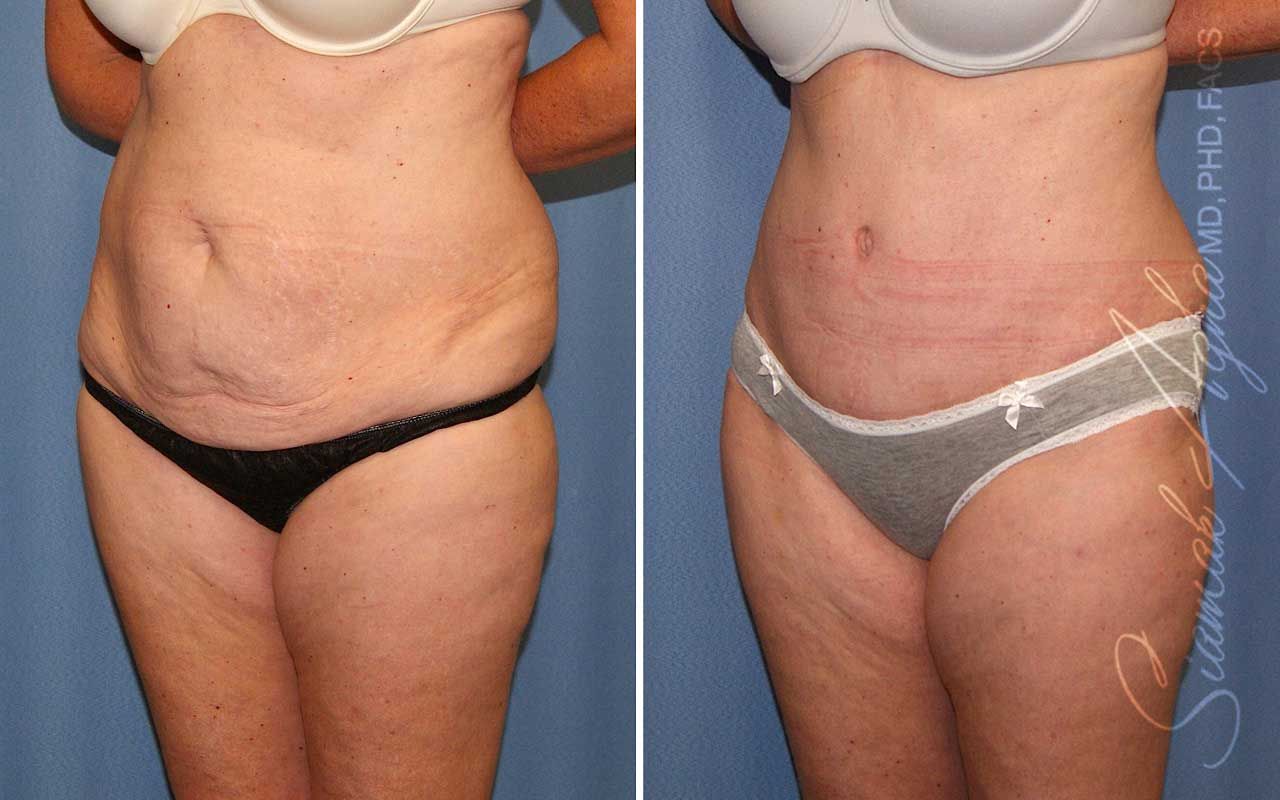 Tummy Tuck Before & After