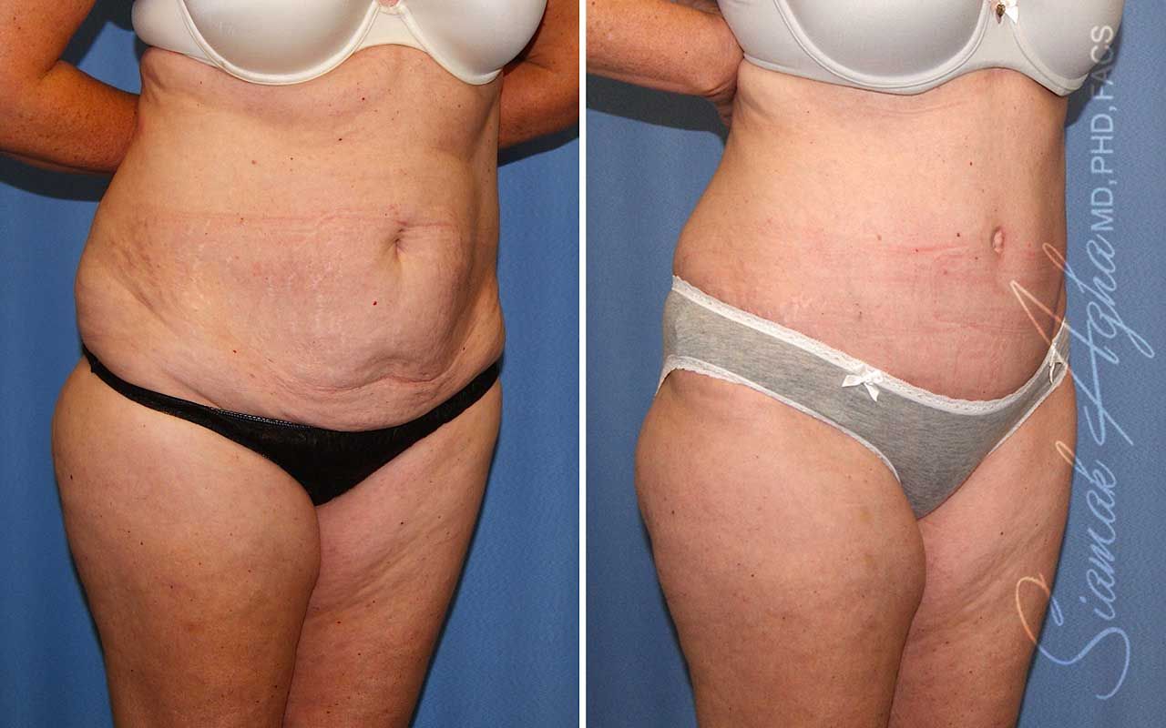 Tummy Tuck Before & After