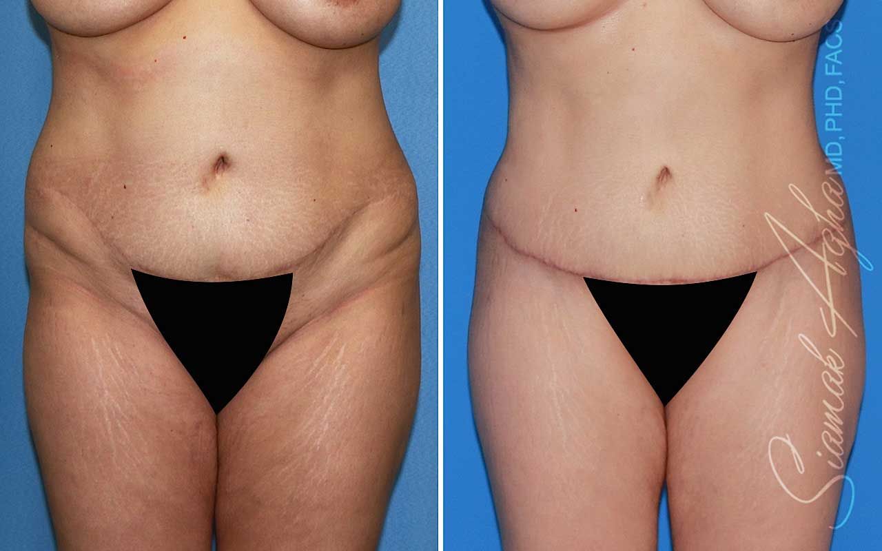 Tummy Tuck Before & After