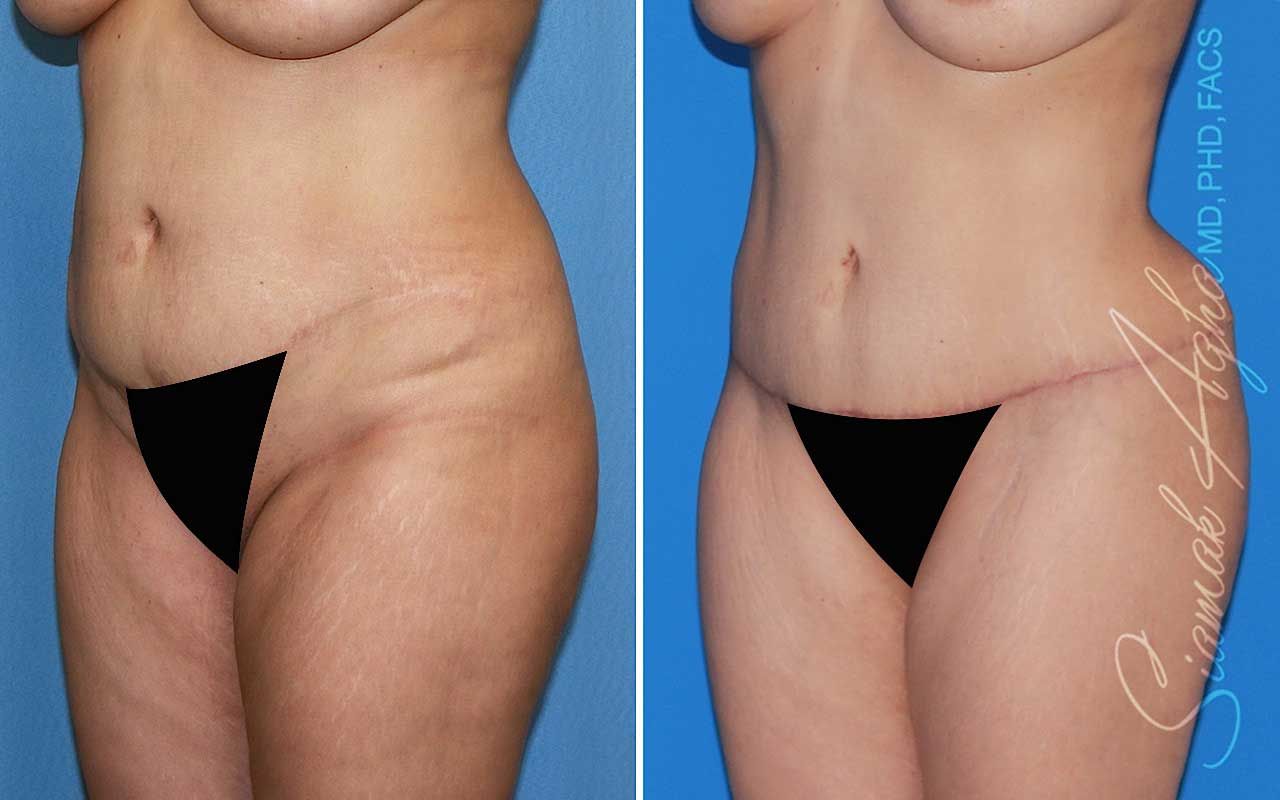 Tummy Tuck Before & After