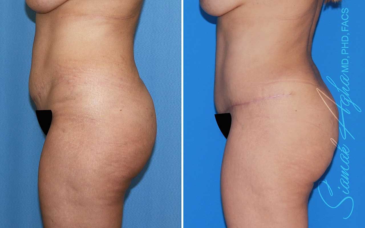 Tummy Tuck Before & After