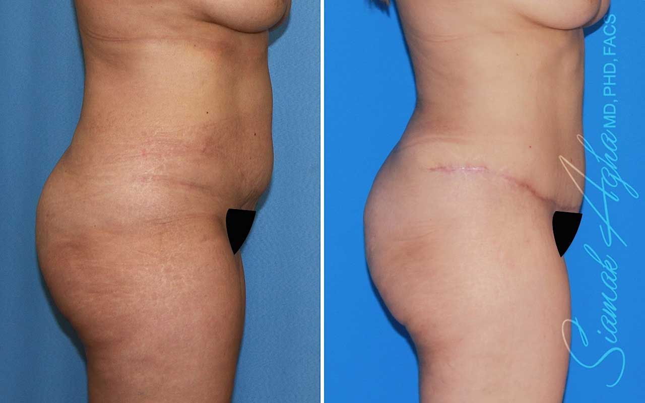 Tummy Tuck Before & After