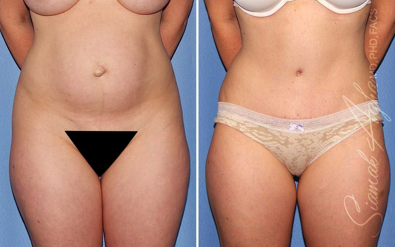 Tummy Tuck Before & After