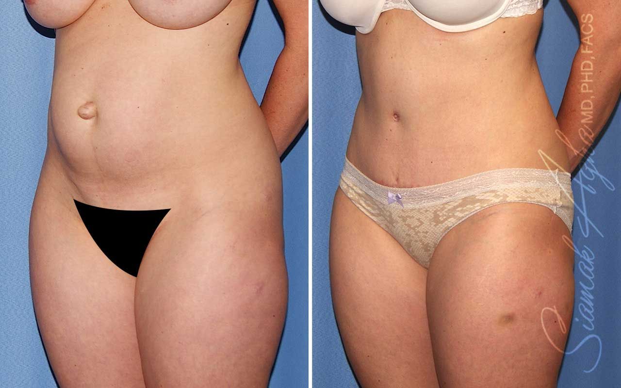 Tummy Tuck Before & After