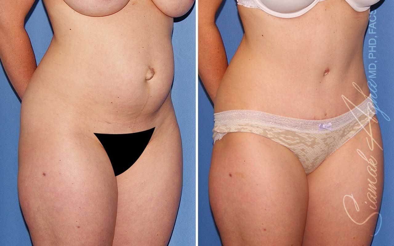 Tummy Tuck Before & After