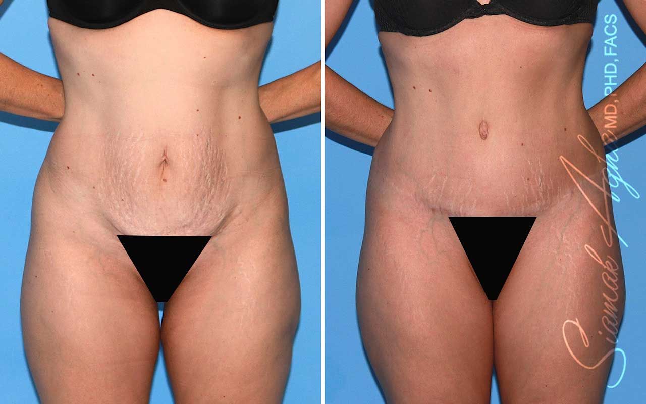 Tummy Tuck Before & After