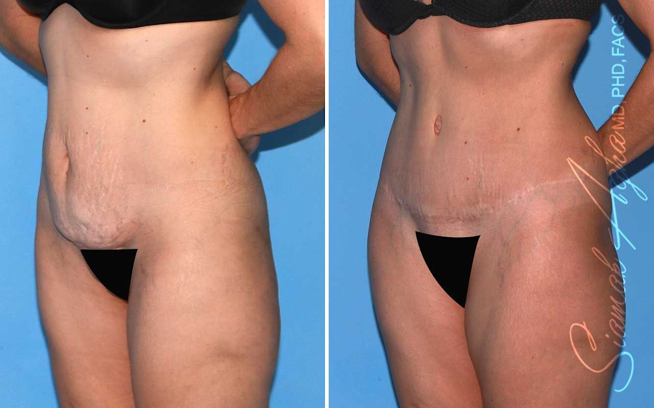 Tummy Tuck Before & After