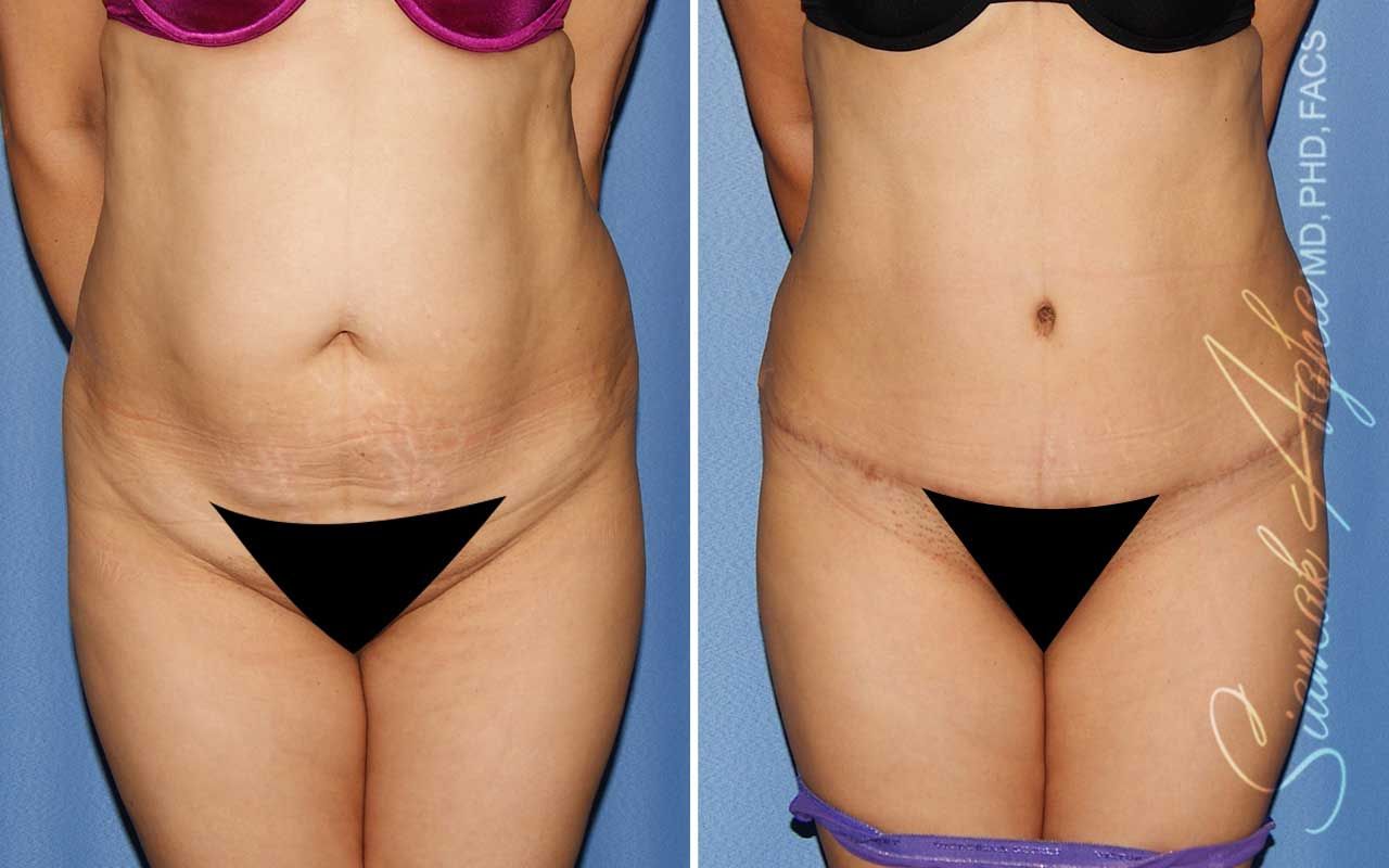 Tummy Tuck Before & After