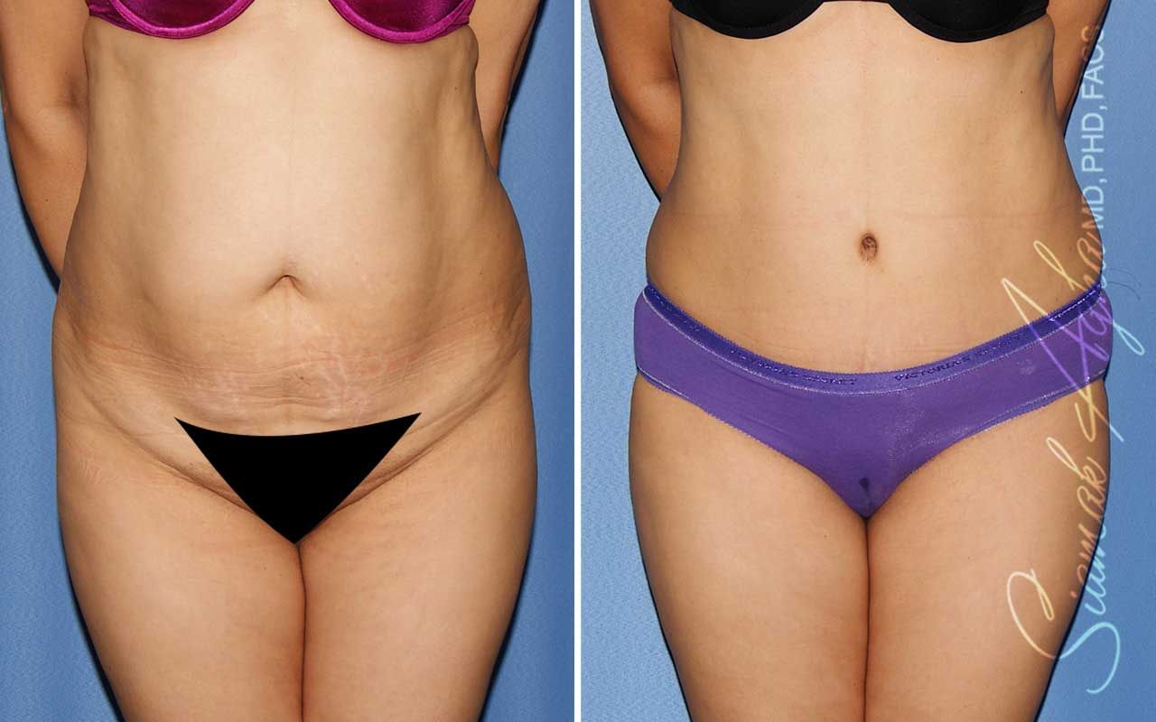 Tummy Tuck Before & After