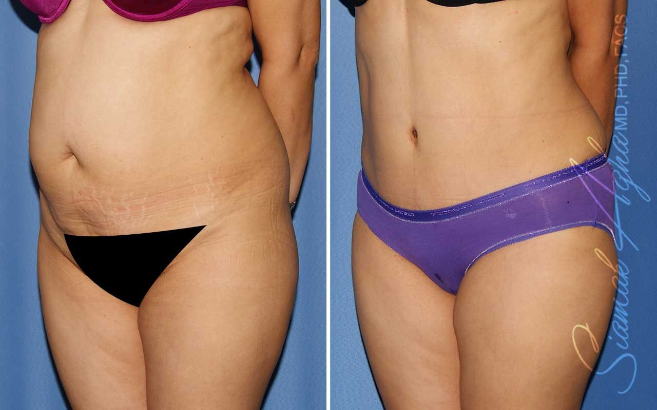 Tummy Tuck Before & After