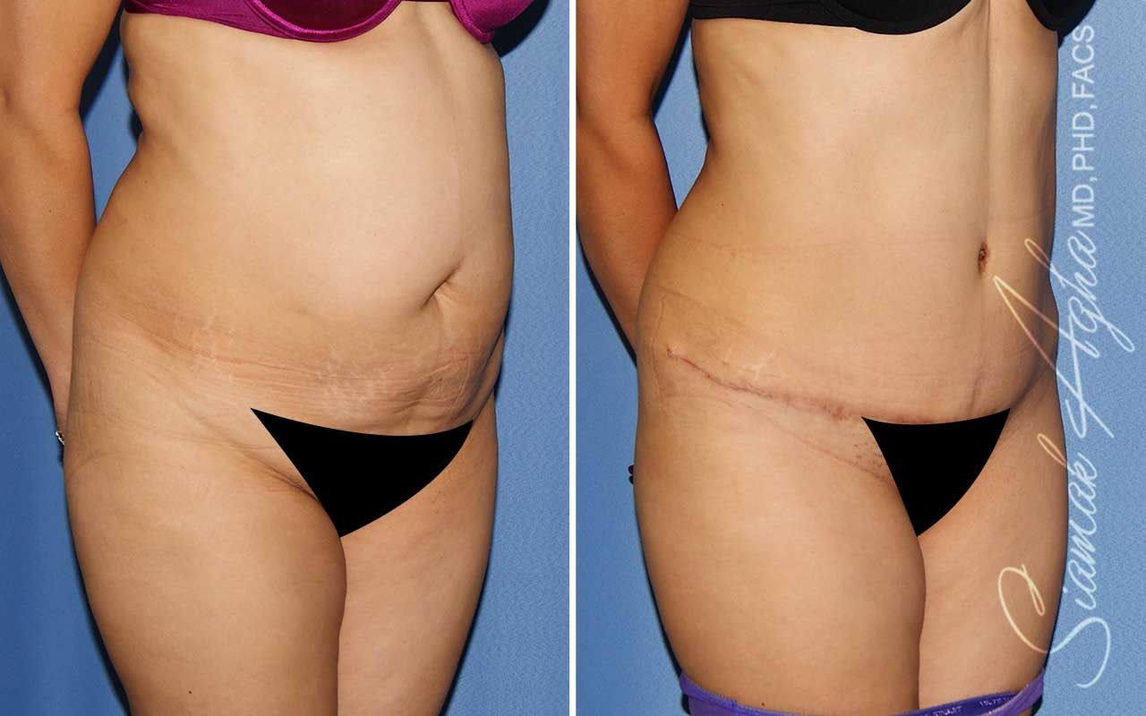 Tummy Tuck Before & After