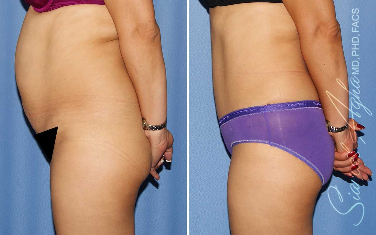 Tummy Tuck Before & After