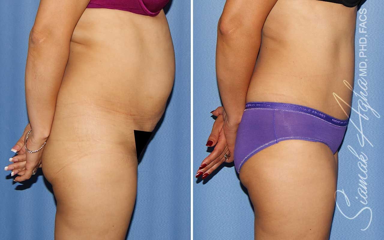 Tummy Tuck Before & After