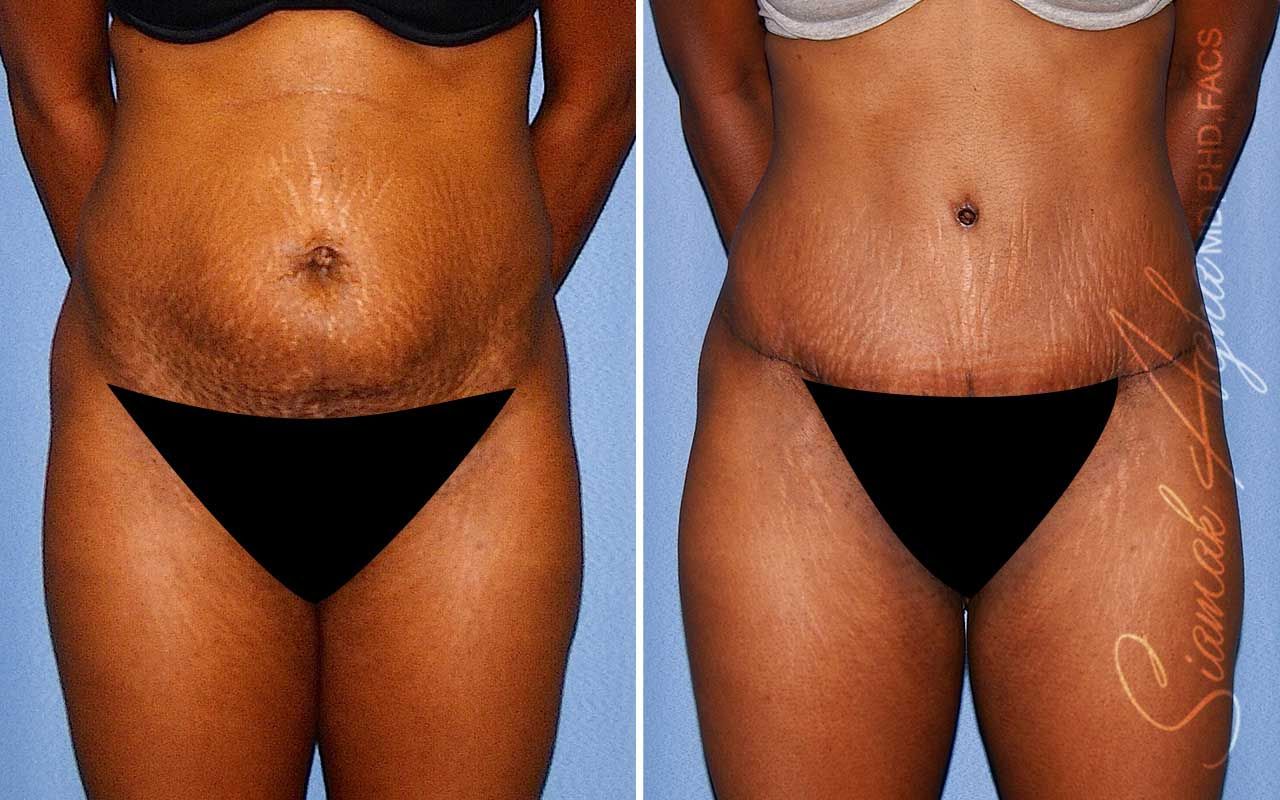 Tummy Tuck Before & After