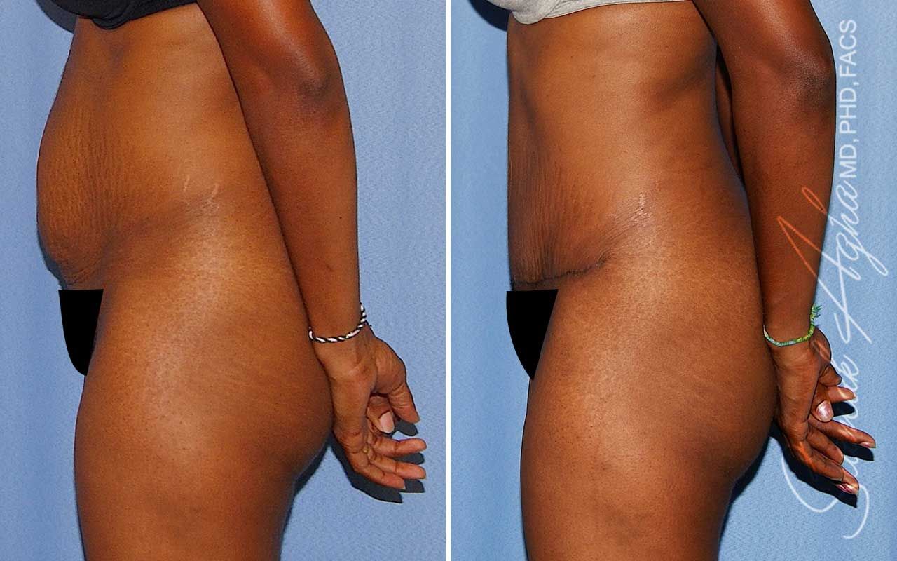 Tummy Tuck Before & After